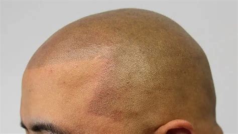 8 Scalp Micropigmentation Regrets And How To .